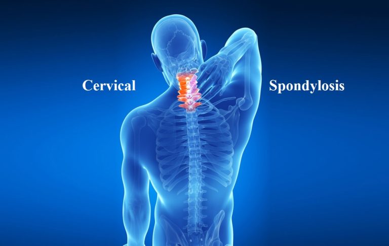 Cervical Spondylosis : Symtoms, Causes and Remedies - InfoDrishti